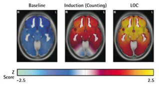 Masimo - EEG Power Shift Diagramm, das Verschiebungen der EEG-Leistung bei Induktion und Bewusstseinsverlust zeigt